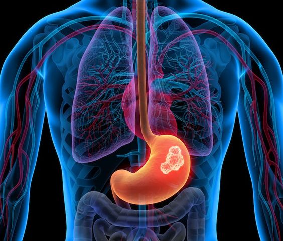 procedure of kidney transplantation